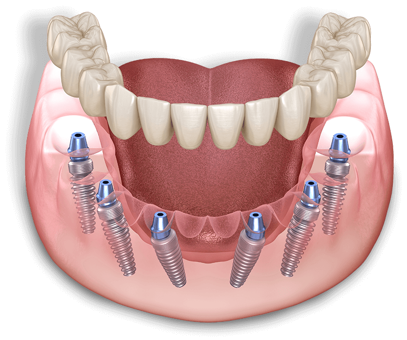 full arch dental implant model