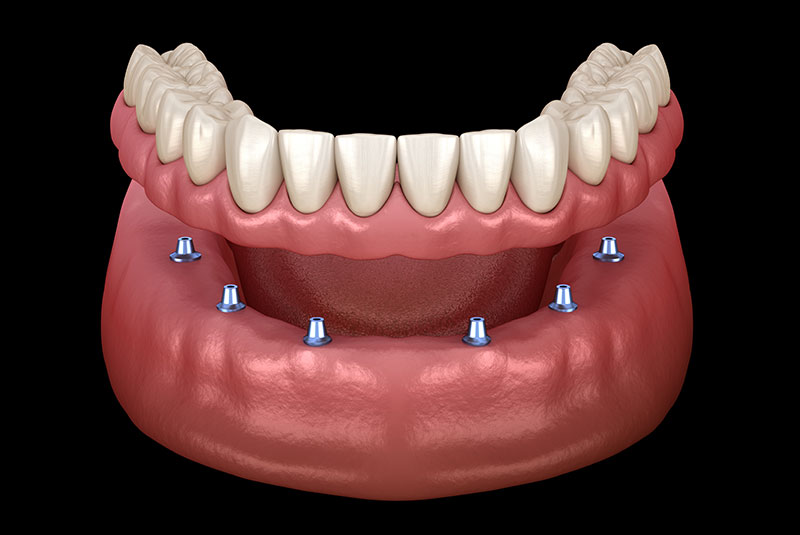 Implant-Supported Dentures