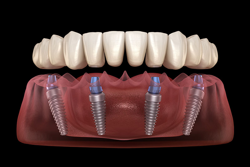 Full-Arch Dental Implants
