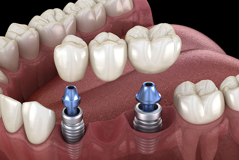 Implant-Supported Bridge