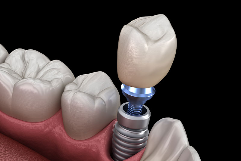 Single Dental Implant